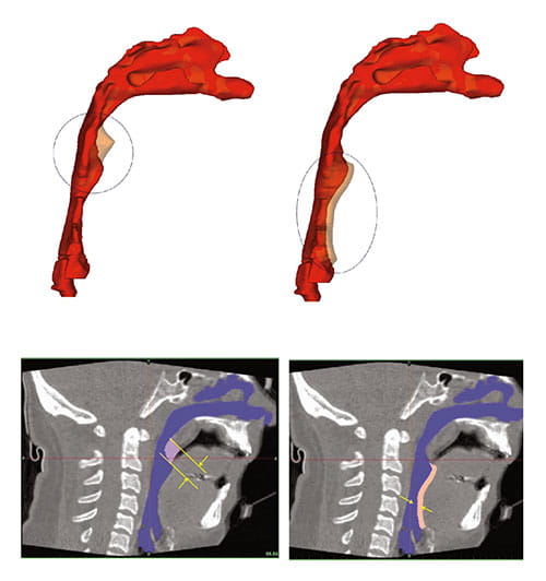 Fig A:  These 3D airway models were reconstructed from respiratory-gated computed tomography and magnetic resonance imaging. These virtual surgeries reflect palate and tongue procedures that demonstrate how surgical changes can affect air-flow resistance.
